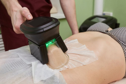 What is Cryolipolysis