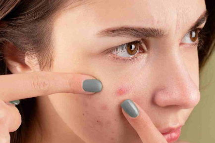 Get Rid of Acne Scars